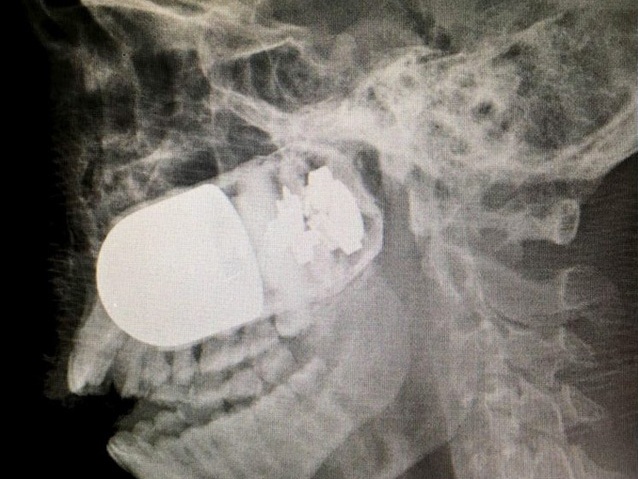 Thoát chết thần kỳ dù bị cả một quả lựu đạn mắc kẹt trong đầu