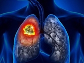 Dấu hiệu cảnh báo bạn đang bị ung thư phổi