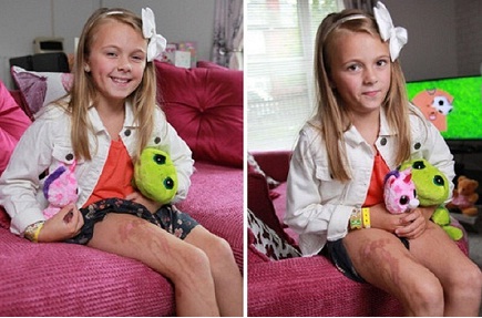 Dùng kem chống nắng, da cháy xém như bị tạt axit