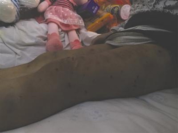Bàn chân bé 2 tuổi bị biến chứng do bỏng nước sôi