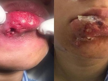 Thiếu nữ lở loét đau đớn sau khi bơm môi gợi cảm