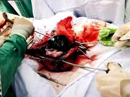 Cứu sống sản phụ mang thai ngoài tử cung hiếm gặp