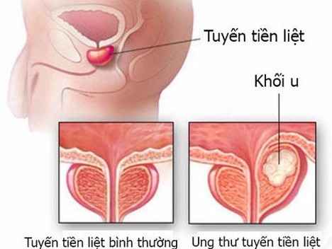 10 căn bệnh ung thư có nguy cơ cao với nam giới