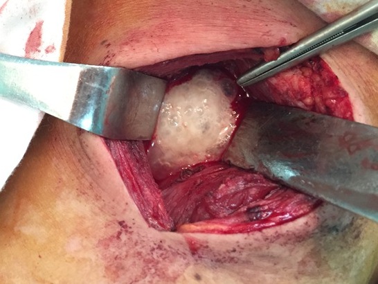 Cứu sống 1 bệnh nhân bị áp xe trung thất do thủng thực quản