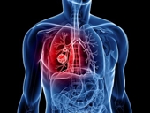 Bệnh ung thư phổi nguy hiểm như thế nào
