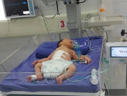 Bé sơ sinh chào đời với nội tạng lộ ra ngoài