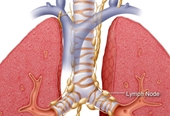 Ung thư phổi và những điều cần biết