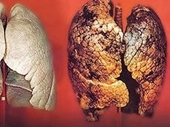 Bị ung thư phổi, phải làm gì để chiến thắng bệnh hiểm nghèo