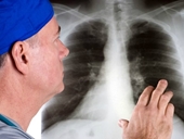 Ung thư phổi gây tử vong số 1 cho đàn ông