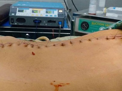 Mổ thành công 2 bướu bụng lớn nghi ác tính