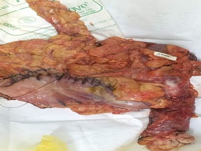 Đau bụng âm ỉ là dấu hiệu báo bệnh ung thư nào