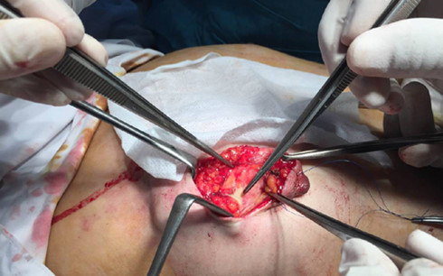 Hỏng ngực vì tiêm silicon dạo