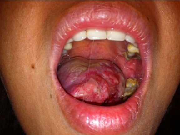 Những con số giật mình về 7 bệnh ung thư do rượu bia mang đến