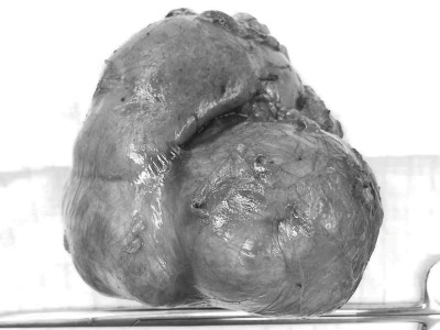 Nữ bệnh nhân mang khối u thận gần 1kg