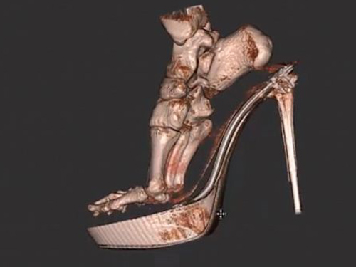  Ảnh 3D mô phỏng bàn chân của người mang giày cao gót. Ảnh: ABC News.