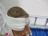 Bị lột toàn bộ da đầu sau tai nạn giao thông, bé gái 2 tuổi được cứu sống
