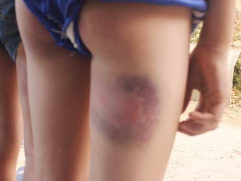 6 nam sinh cấp hai bị thầy giáo chủ nhiệm đánh bầm đùi