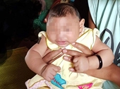 Việt Nam ghi nhận em bé đầu tiên mắc chứng đầu nhỏ do virus Zika
