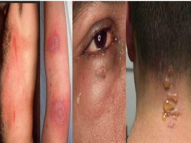 Nhận diện tổn thương điển hình do kiến ba khoang