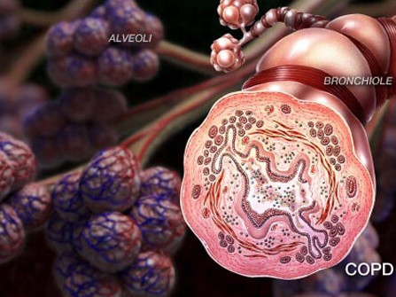 Gánh nặng điều trị bệnh phổi tắc nghẽn mãn tính ở Việt Nam