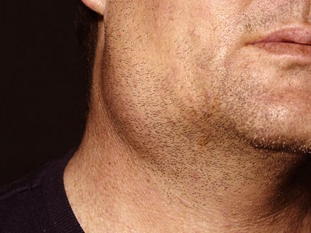 Nỗi ám ảnh… teo tinh hoàn sau quai bị