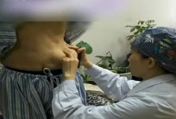 Miếng keo độn ngực trôi tuột xuống bụng sau vài năm phẫu thuật