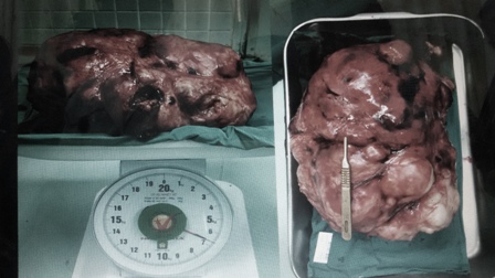 Cả xã hội đang oằn mình vì gánh nặng ung thư