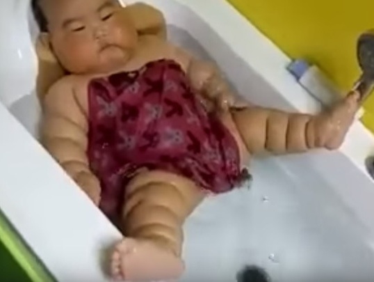 Chân tay nhiều ngấn, cẩn thận trẻ mắc bệnh Michelin