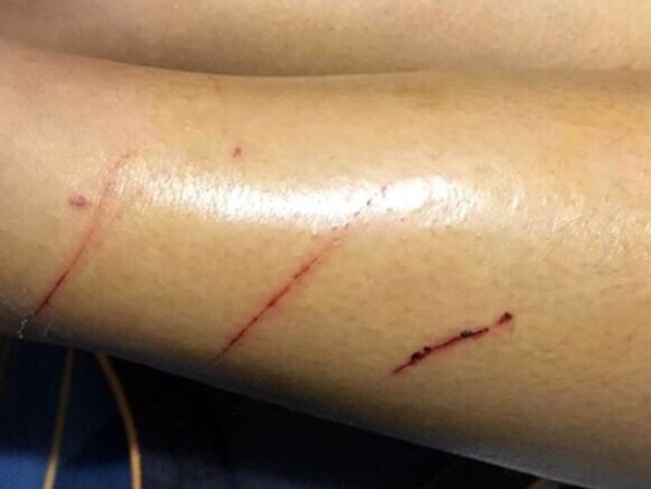 Xác minh thông tin kẻ biến thái rạch đùi nữ sinh tại Hà Nội