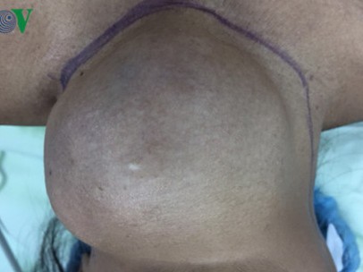 Bệnh nhân 18 năm mang khối u nặng 1,2kg ở cổ