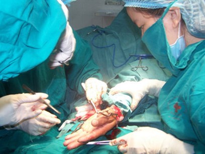 Bắt nghi can chém lìa bàn tay đối thủ khi đấu dao