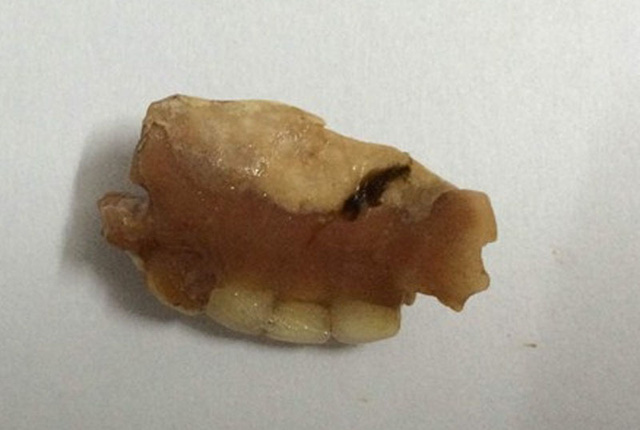 Tức ngực, khó thở vì răng giả chui vào dạ dày