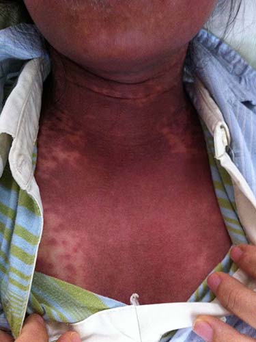 Dị ứng thuốc ngày càng đáng sợ