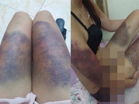 Thiếu phụ tố bị bạn trai tra tấn bầm tím khắp người