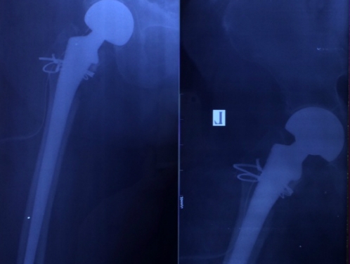 Thay khớp cho cụ bà 102 tuổi gãy xương đùi