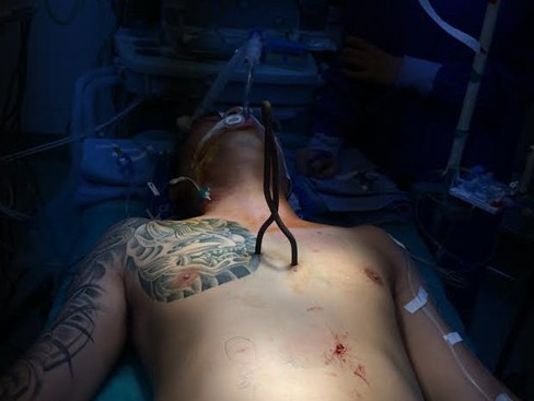 Cứu sống bệnh nhân bị vật nhọn đâm 6 lỗ thủng ở tim