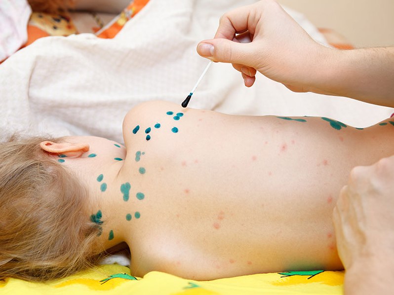 Chữa thủy đậu sai cách sẽ nguy hiểm đến tính mạng của trẻ