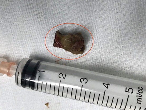 Ho dữ dội suốt 3 năm vì hóc xương gà