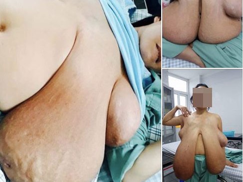 Hiếm gặp ca ngực khủng và dài tới quá bẹn