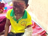 Ngã vào bếp lửa, cháu bé 5 tuổi bị lột toàn bộ da mặt