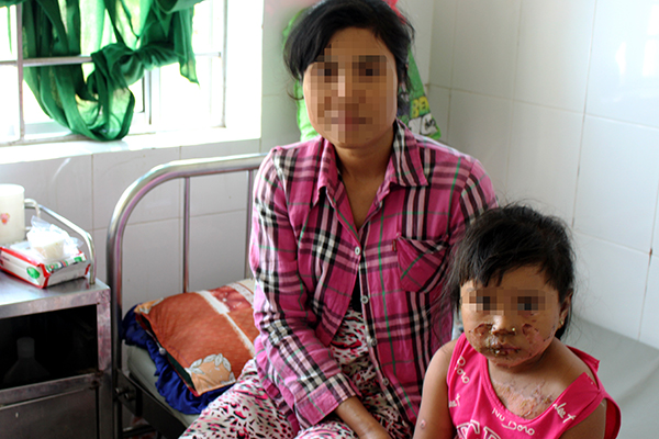 Một bé gái bị bỏng nặng do anh trai nhóm lửa bằng xăng
