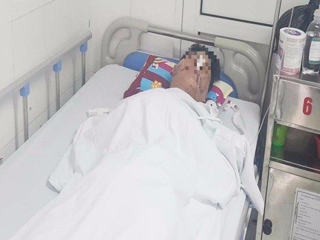 Đưa đầu vào miệng cá sấu, nam diễn viên bị cắn nát mặt