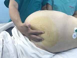 Bóc khối u 20 kg trong bụng cụ bà U80