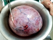 Bệnh viện huyện ở Yên Bái mổ lấy khối u nặng 5,5kg cho bệnh nhân