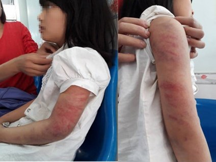 Khởi tố người đàn ông nghiện rượu đánh đập con gái dã man