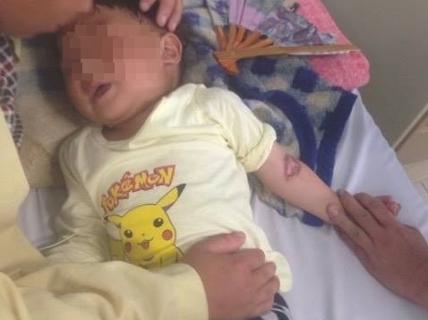 Nhầm gói hóa chất là đường, bé trai 3 tuổi bị bỏng thực quản - dạ dày