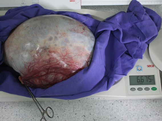 Khối u nặng hơn cặp song sinh chiếm toàn bộ ổ bụng người phụ nữ