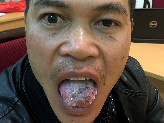 Cô gái cắn gần đứt lưỡi kẻ hiếp dâm