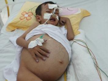 Coi chừng khi trẻ vàng da quá 15 ngày