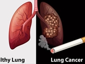 Ung thư phổi giết chết 90 người mắc bệnh này ở Việt Nam